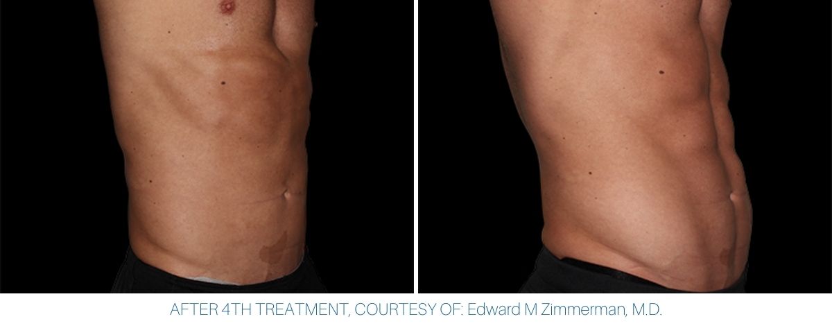 Abdomen before and after Emsculpt NEO treatment with impressive results.