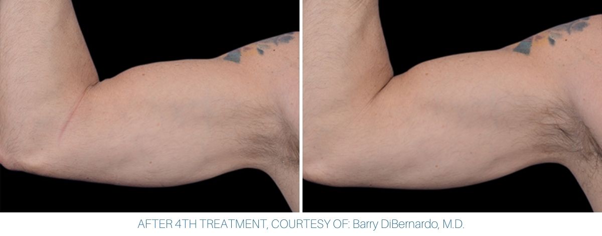 Bicep showing impressive increase in muscle with Emsculpt NEO.